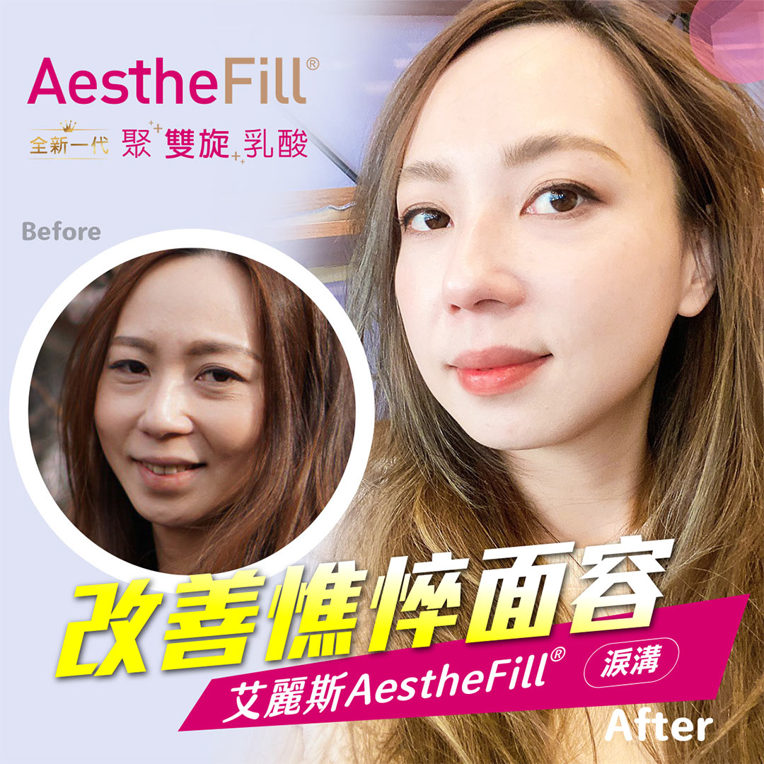 艾麗斯AestheFill®精靈針新型PDLLA聚雙旋乳酸針案例分享-02