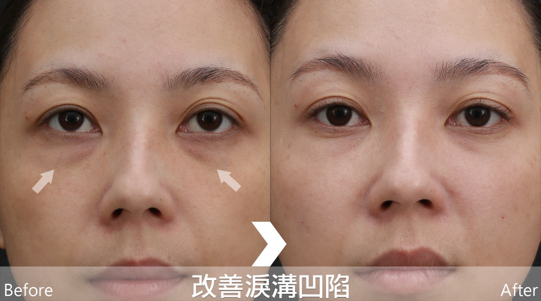 艾麗斯AestheFill®精靈針新型PDLLA聚雙旋乳酸針案例分享-04