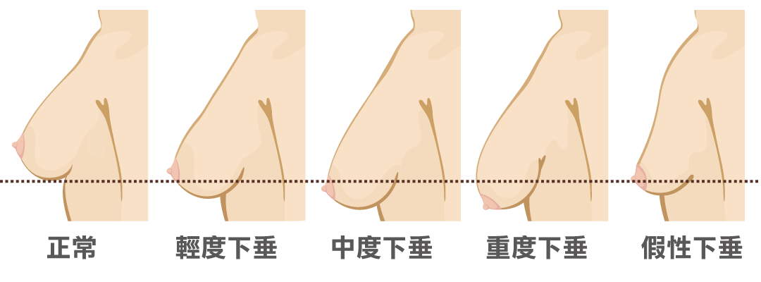 提乳、縮乳頭、縮乳暈手術方式