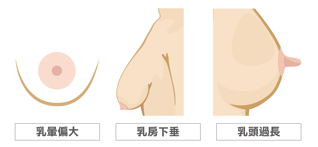 乳暈偏大/乳房下垂/乳頭過長困擾