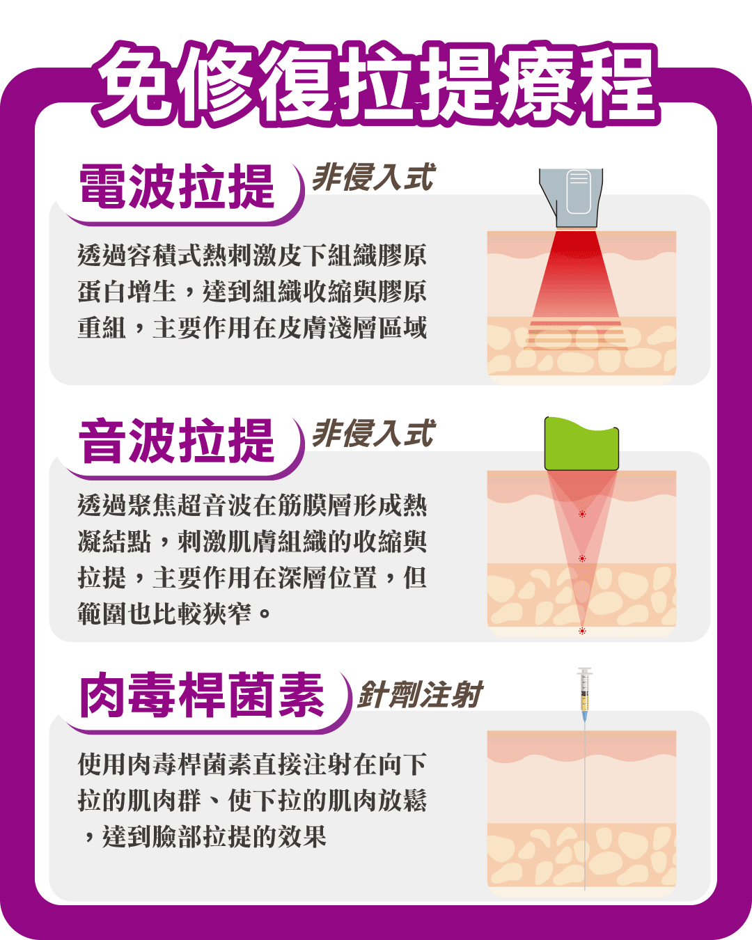 免修復拉提療程｜電波拉提｜音波拉提｜肉毒桿菌素