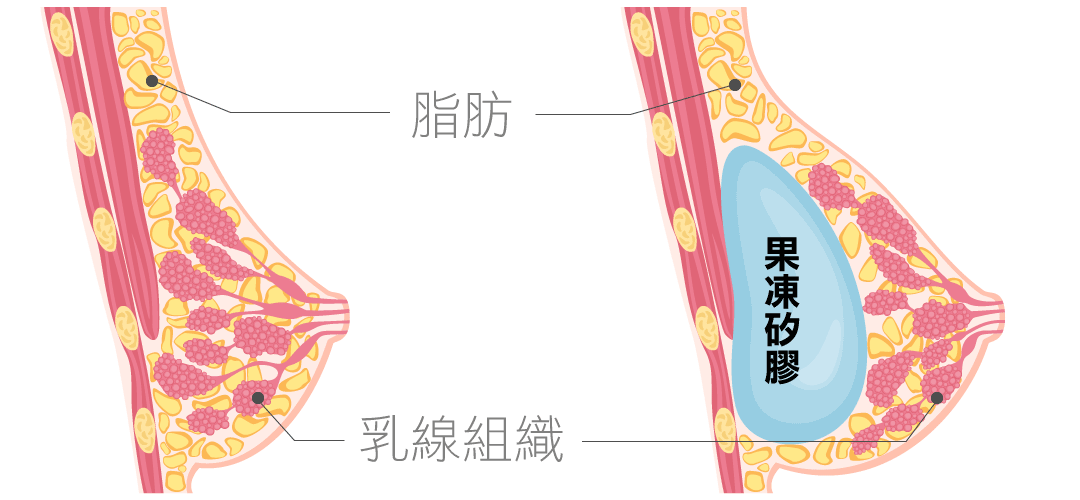 隆乳假體形狀｜水滴型隆乳假體