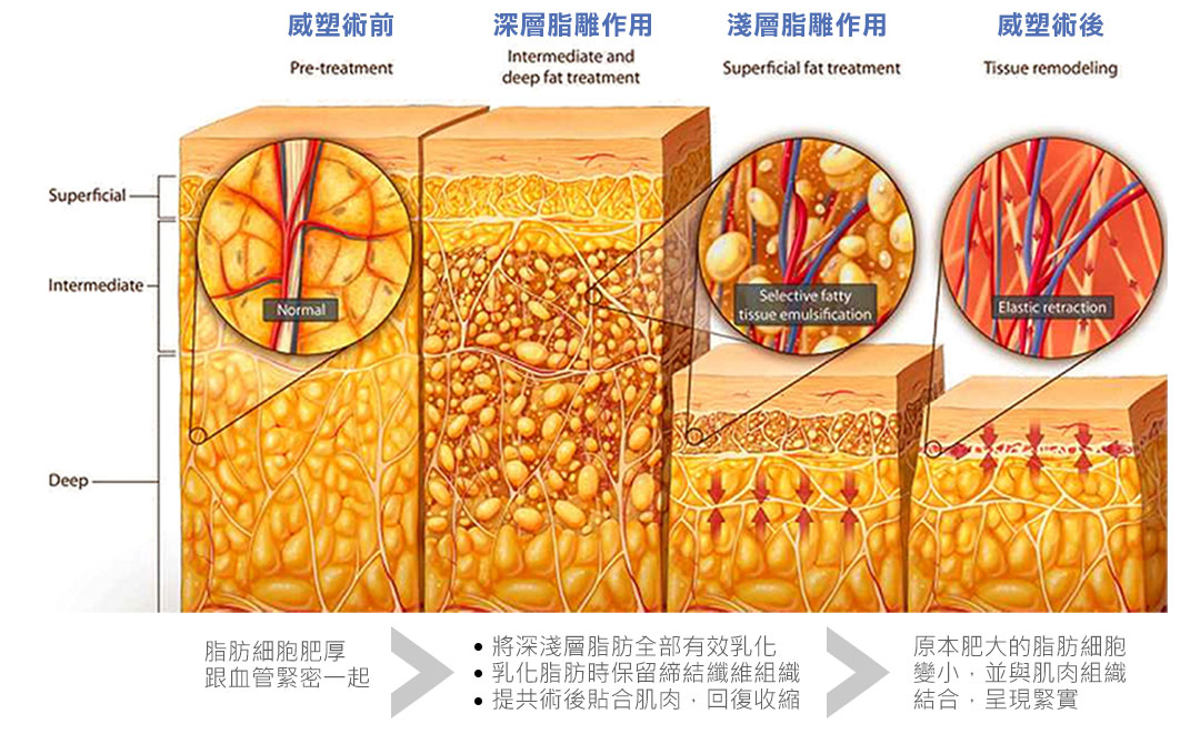 台中抽脂VASER威塑抽脂原理說明圖示-01