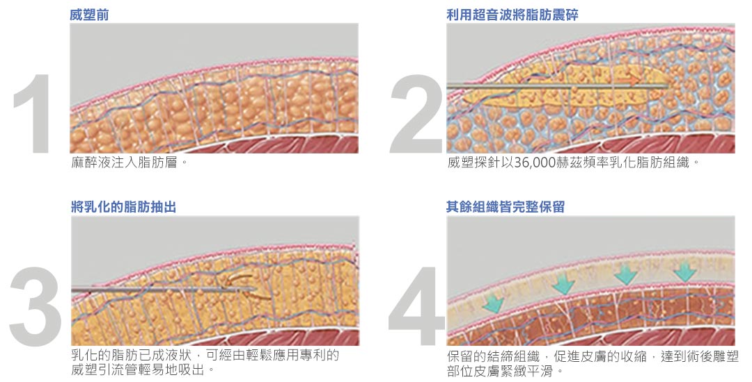 台中抽脂VASER威塑抽脂原理說明圖示-02