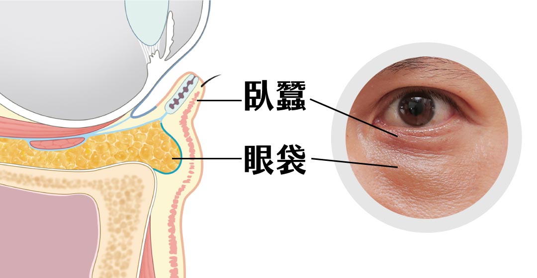 分辨臥蠶與眼袋的區別