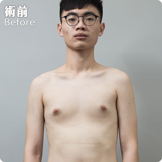 周爾康整形外科診所男性女乳手術案例-03