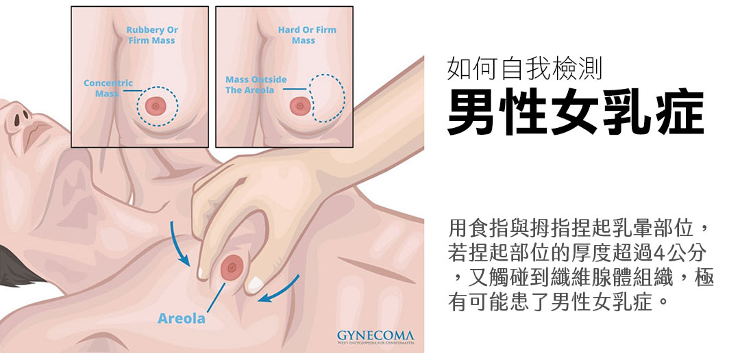 男性女乳症自我檢測方式