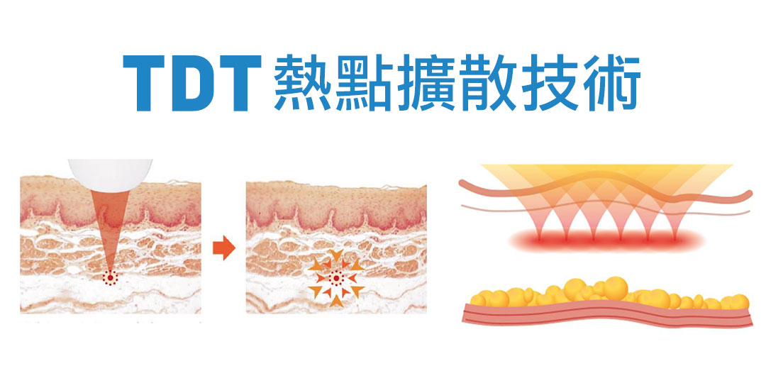 渦漩音波TDT熱點擴散技術