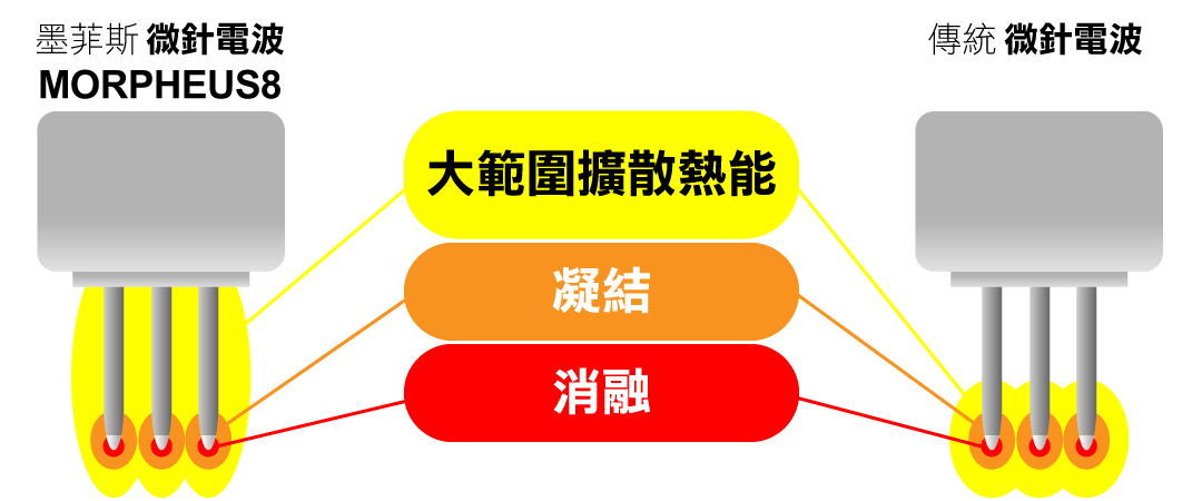 MORPHEUS8微針電波（夢神電波）VS傳統微針電波