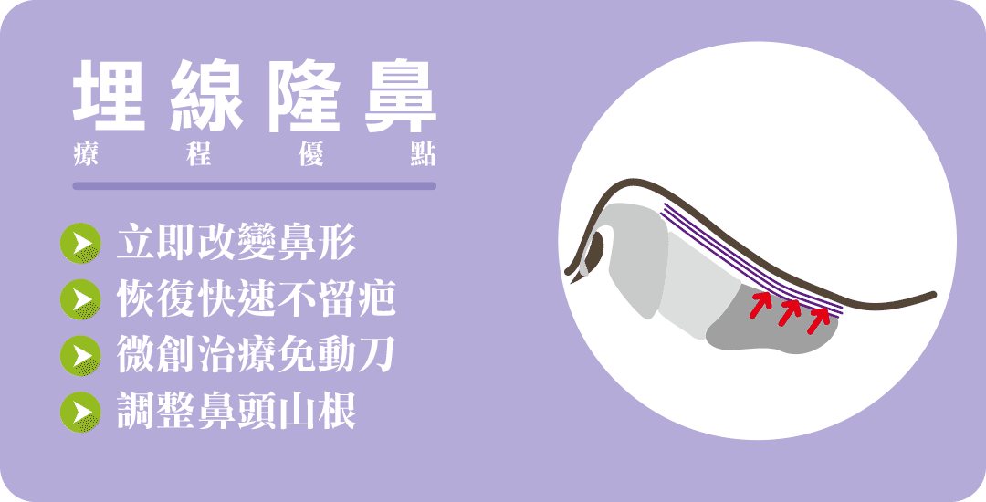 埋線隆鼻手術優點