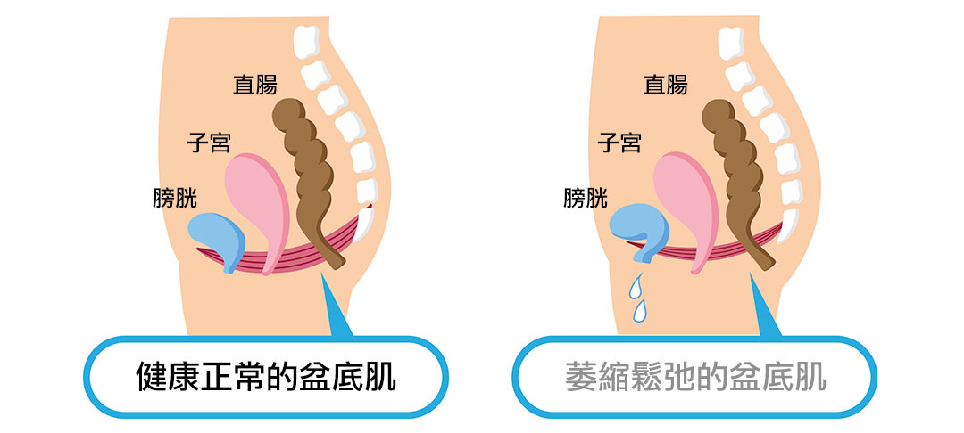 正常健康的盆底肌VS萎縮鬆弛的盆底肌