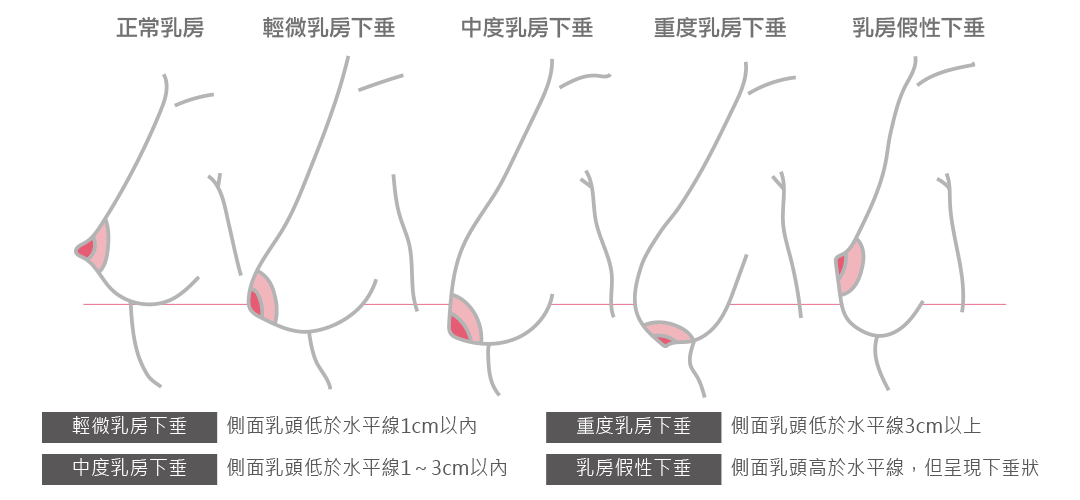 如何判斷是否胸部下垂｜判斷胸部下垂的方式