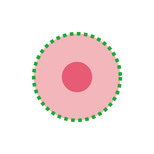 平胸手術方式：乳暈環切平胸手術疤痕樣子