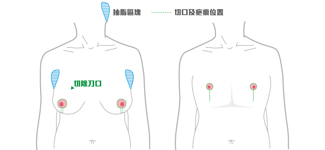 平胸手術方式：棒棒糖平胸手術