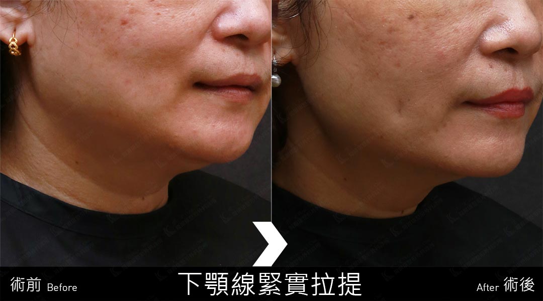 Q+音波拉提案例分享-05